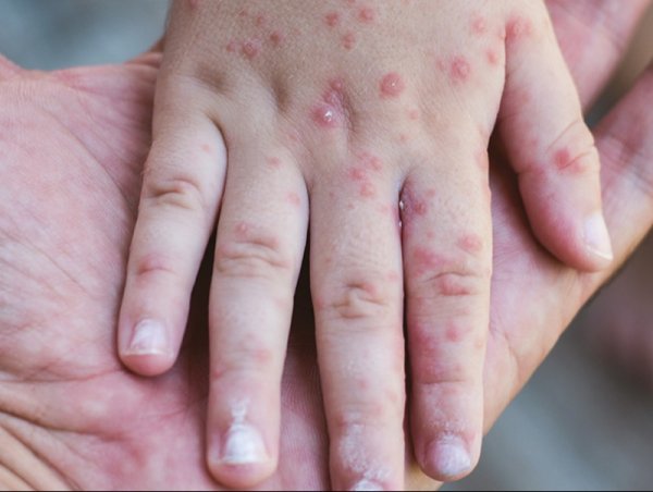 Өмнөговь аймагт улаанбурхан өвчний тохиолдол батлагджээ